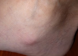 Nodule on inside right ankle