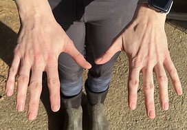 Recent joint swelling in right hand 