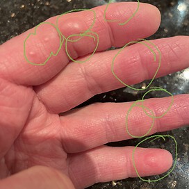 Photo of knots on fingers