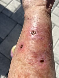 My initial infection