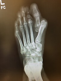 Foot X-Ray Before First Surgery