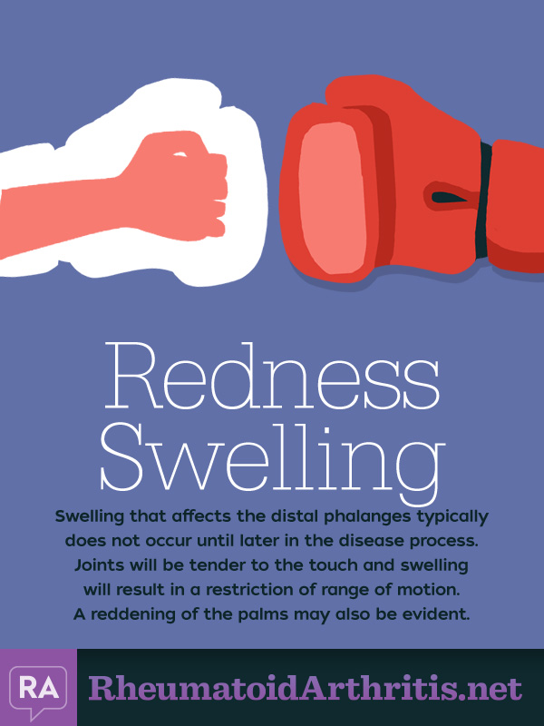 Redness Swelling Common RA Symptom