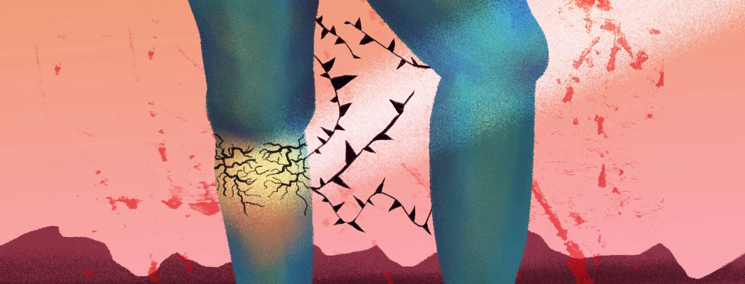 Legs with veins like thorns