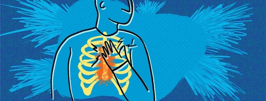 RA Chest Pain (Costochondritis) image