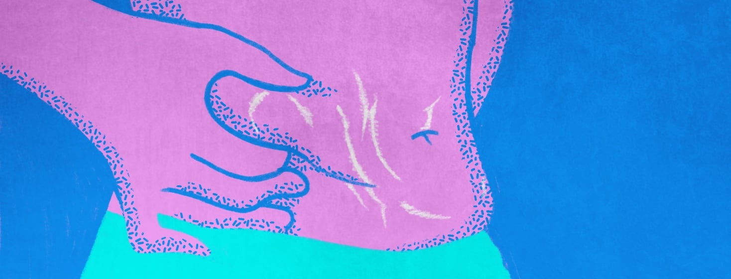 A person is pinching their midsection. In their stomach area is a variety of stretch marks on their skin.
